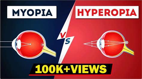 Difference Between Myopia And Hyperopia Near And Farsightedness