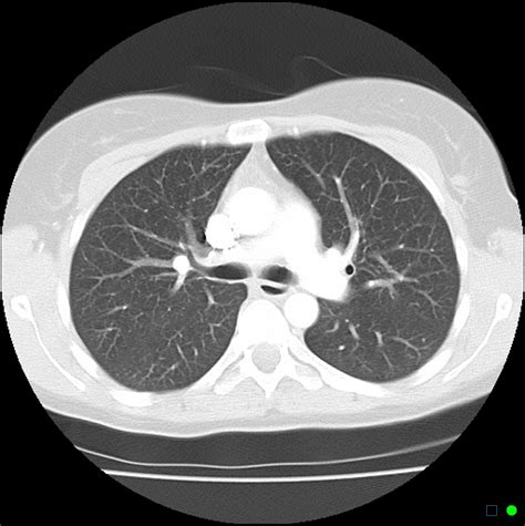 Normal Chest Ct Scan