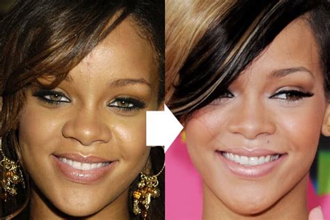 Celeb Surgery Rihanna Plastic Surgery Before And After Celeb Surgerycom