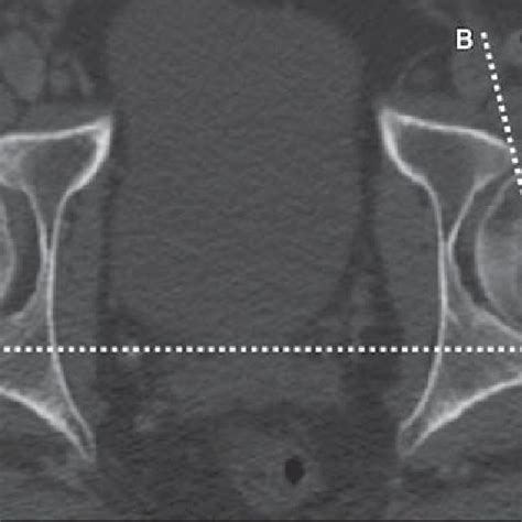 Ct Scan Shows Angle Of Acetabular Version Line A Is Drawn Between Both