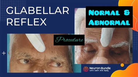 Glabellar Reflex Myersons Sign Reflexpathway Cranialnerves