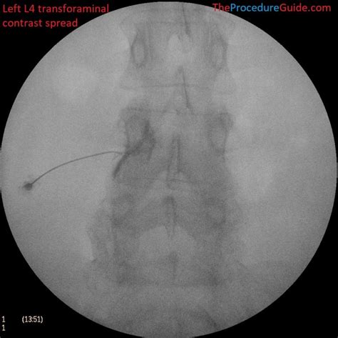 Fluoroscopic Guided Thoraciclumbar Transforaminal Epidural Steroid