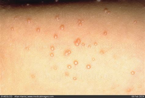 Stock Image Close Up Of Molluscum Contagiosum Showing Multiple Small