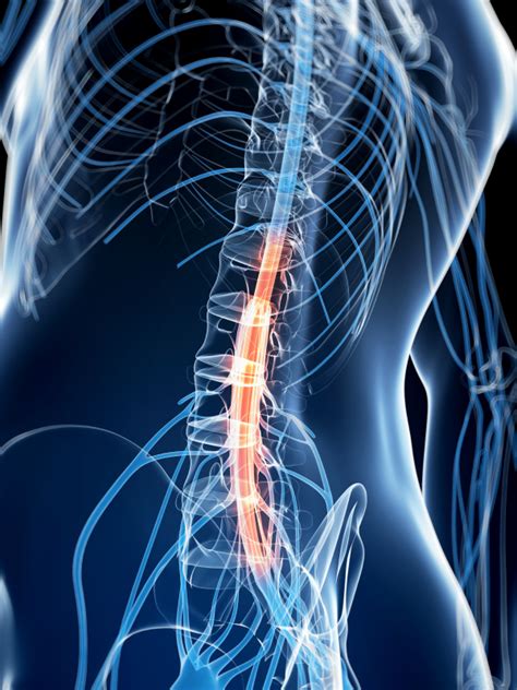 Spinal Stenosis Michigan Spine And Pain