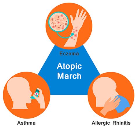 What Is Atopic March And How To Treat It