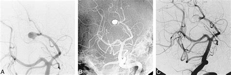 Aneurysms Of The Posterior Cerebral Artery Classification And
