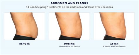 Coolsculpting Before During And After Images Real Patient Results