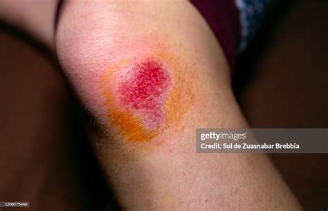 Closeup Of A Large Erosion Wound Scrape With Burn Freshly Made Red With