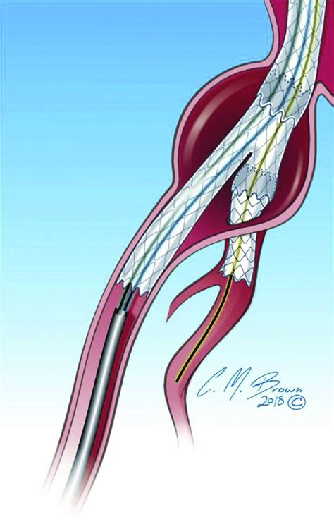 The Iliac Branch Endoprosthesis Endovascular Aortic Aneurysm Repair