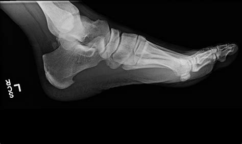 Ortho Dx Suspected Plantar Fasciitis Clinical Advisor