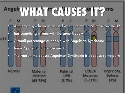 Angelman Syndrome Karyotype Chromosome 15 Acne Symptoms