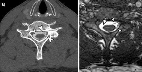 A Computed Tomography Myelography Of The Cervical Spine Axial Image At