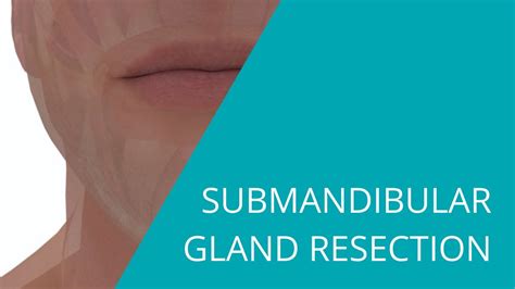 Submandibulectomy How To Perform A Submandibular Gland Resection