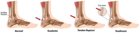 A tendon is a band of tissue that the main function of the peroneal tendons is to stabilize the foot and ankle and protect them from sprains. Patient Care & Pain Treatment Solutions | Arthritis ...