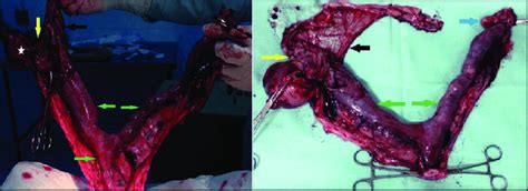 Intraoperative Photograph During And After Ovariohysterectomy Showing