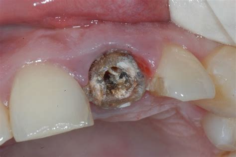 Infection In Gum After Tooth Removal