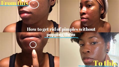 How To Get Rid Of Pimples Without Popping Them My Acne Prevention
