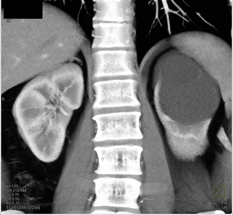 Bosniak Ii Cyst Kidney Case Studies Ctisus Ct Scanning