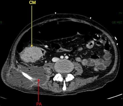 Psoas Abscess And Severe Fasciitis Due To A Caecal Carcinoma Bmj Case