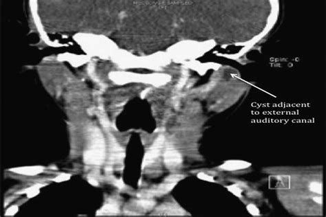 Work Type Ii First Branchial Cleft Cyst A Rare Anomaly With