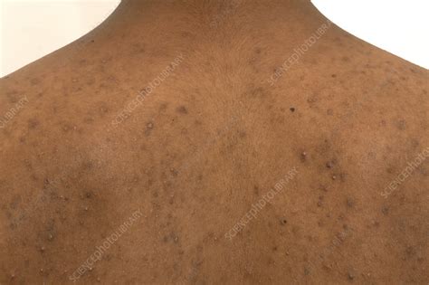 Acne Vulgaris Stock Image C0500954 Science Photo Library