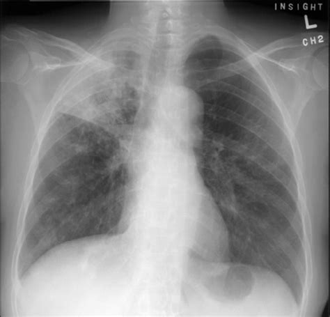 Tuberculosis And Mycobacterial Pneumonia The Clinical Advisor
