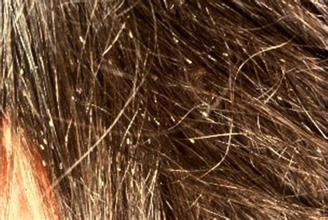 Super Lice Cases Rise 30 Percent Nationwide