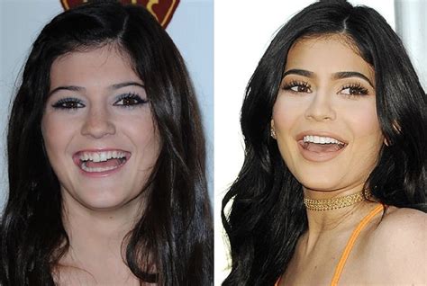 Kylie Jenner Before Kylie Jenner Before And After Nose Job Lip Injections Breast Kylie