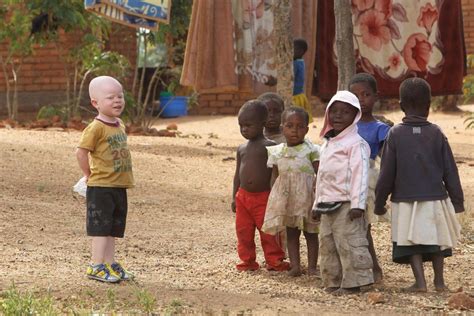 What Is Albinism How Does It Affect Skin Colour What Are The Symptoms And Are There Any