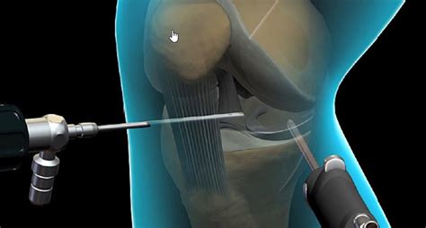 Knee Arthroscopy Mediheal Group Of Hospitals