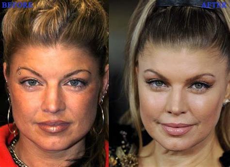 Fergie Plastic Surgery Photo Before And After Celeb Surgerycom