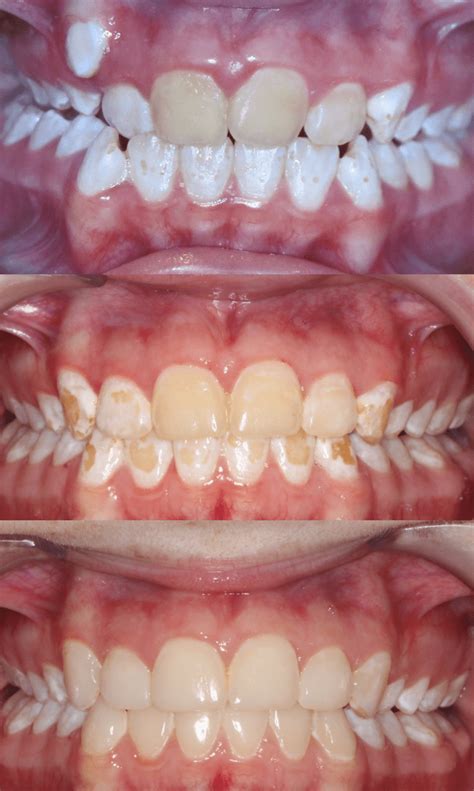 Case Study 59 Brown Stains On Teeth Bandeen Orthodontics Battle Creek