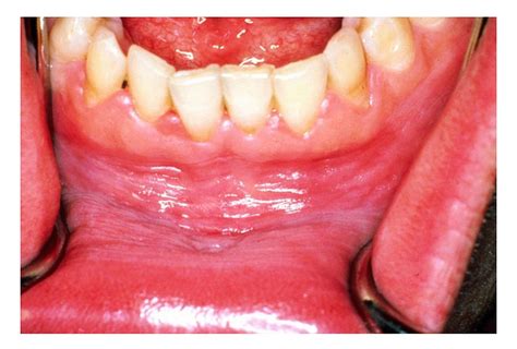 What Does It Mean When You Have White Gums