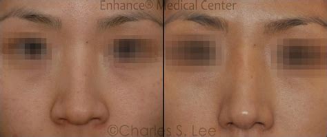 Open Rhinoplasty And All Natural Tissue Rhinoplasty Charles S Lee Md