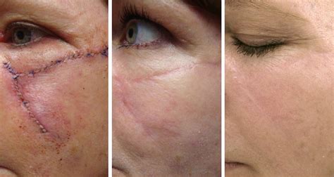 Scar Revision With Sciton Profractional® Laser In Medford Or Pure Medspa