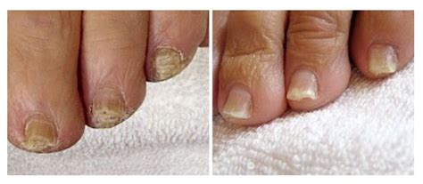 Laser Treatment Of Fungal Nail Infections Estetical