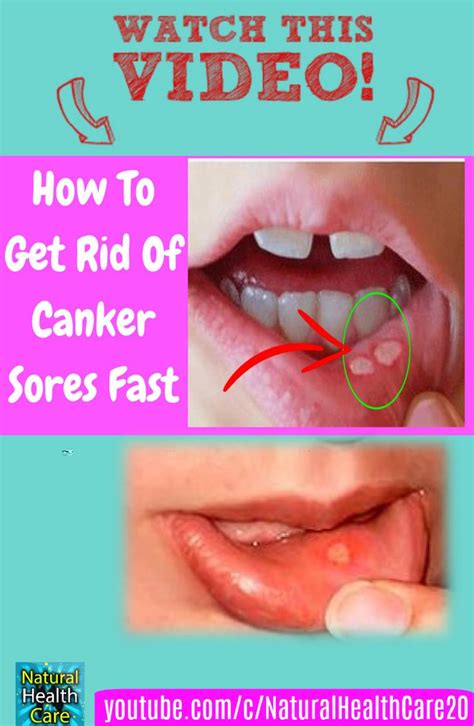 The 25 Best Sores On Tongue Ideas On Pinterest Sore