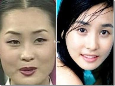 The desire for a thin nose with narrow nostrils has been driving many celebrities to go for a nose job. Plastic Surgery Examples: July 2013