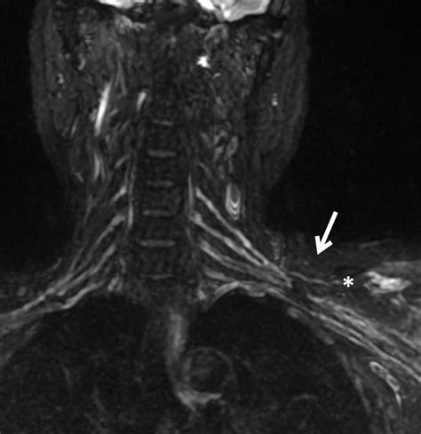 Role Of Magnetic Resonance Imaging In Localization Of Acute Brachial