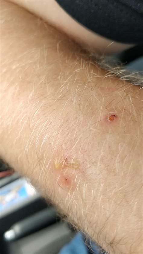 Water Blisters After Mosquito Bites Peepsburghcom