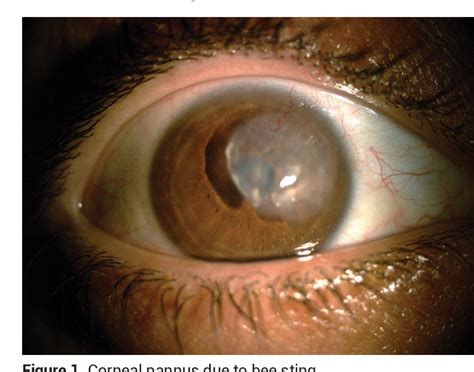 Figure 1 From Management Of Corneal Pannus Caused By Late Stage
