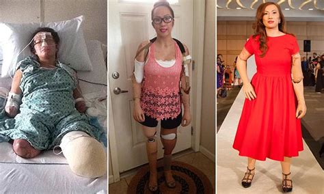 Model Karen Crespo Who Lost All Four Limbs To Meningitis Is A Human