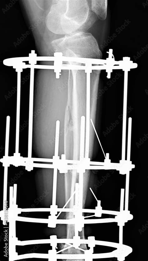 X Ray Of The Tibia With A Fracture Of The Tibia Fixed By An External