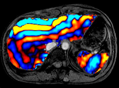 New Ultrasound Technique Developed For Diagnosing And Tracking Liver