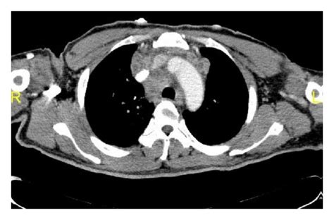 Computed Tomography Of Chest Showing Mediastinal Adenopathy With