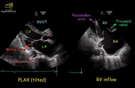 The Rv Inflow View Nephropocus