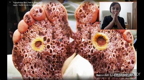 Do You Have Trypophobia When You Are Sick And You Dont