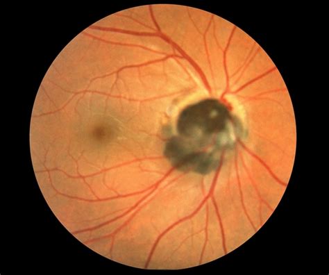 Optic Disc Melanocytoma Retina Image Bank