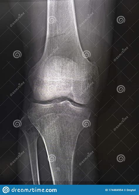 X Rays Of The Knee Joint Close Up Stock Photo Image Of Inflammation