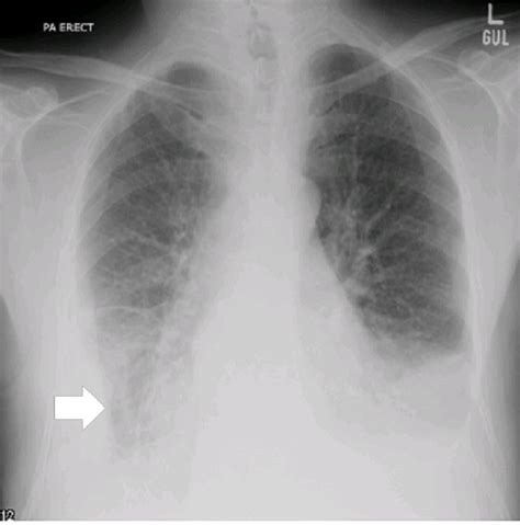 Approximately 1 million people develop this abnormality each year in pleural effusion is the accumulation of fluid in the pleural space resulting from disruption of the homeostatic forces responsible for the movement of. Cureus | Constrictive Pericarditis Presenting as Bilateral ...